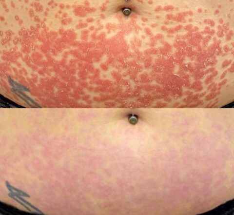 Eczeem Psoriasis Advanced Laser Eczeem Psoriasis Advanced Laser